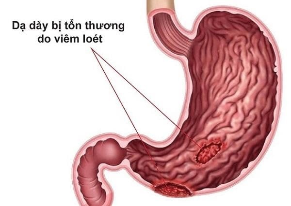 Be careful with the symptoms of stomach ulcers that cause early cancer