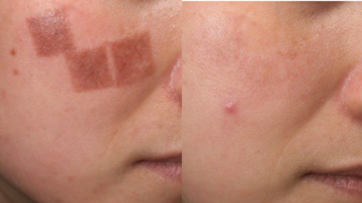 Một trường hợp điều trị nám biến chứng (do laser sai cách) tại DRH Clinic.