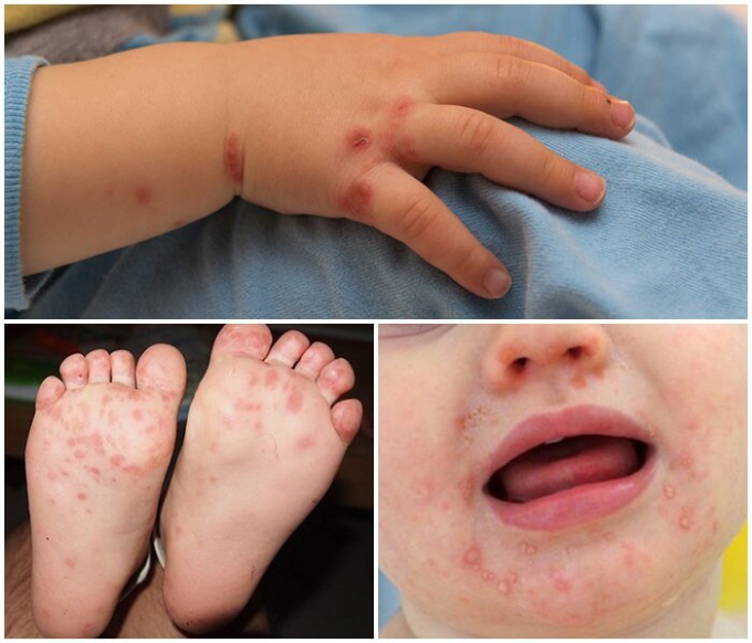 Hand, foot and mouth disease patients have sudden changes in the head and how to prevent it, picture 1