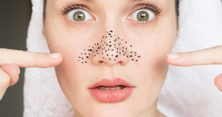 Blackheads on the nose are annoying to many people.