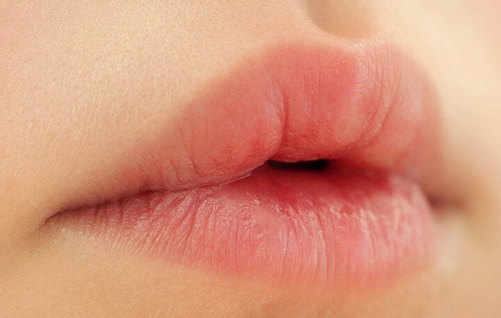 Geschwollene Lippen können durch Nahrungsmittelallergien, Arzneimittelallergien, atopische Allergien usw. verursacht werden.