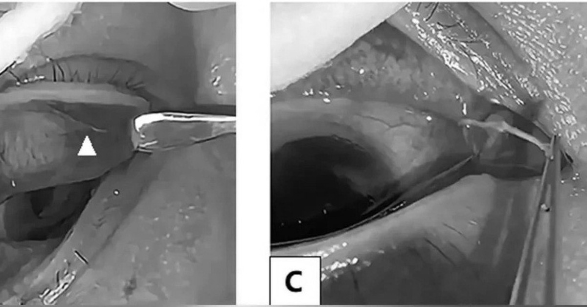 Bác sĩ phát hiện giun sống dưới mí mắt của một phụ nữ