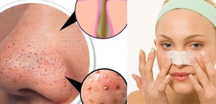 We need to be careful when squeezing blackheads to avoid damaging the skin.