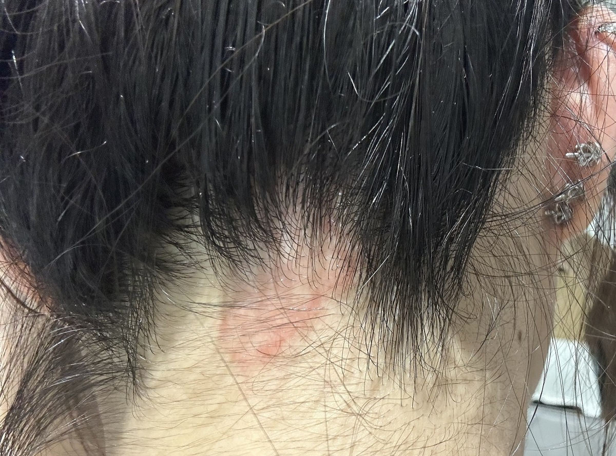 Skin irritation from hair dye