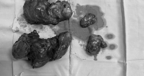 Removing a 600 gram goiter that has been 'haunting' the patient for 35 years