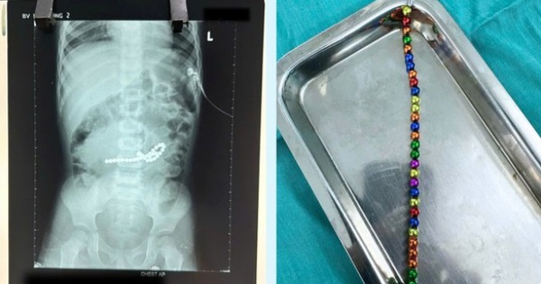 Stomach ache, 3 year old child in Ho Chi Minh City went to the doctor and discovered multiple perforated intestines after swallowing 31 toy magnets