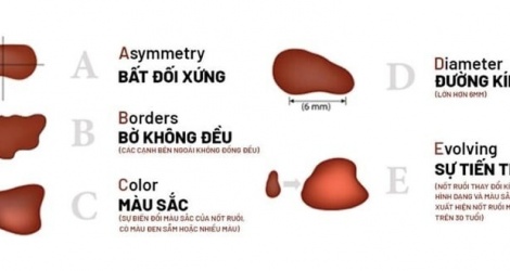 Tăng nhanh lượng bệnh nhân mắc ung thư tế bào hắc tố