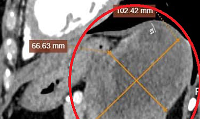 Bösartiger Tumor so groß wie eine Niere