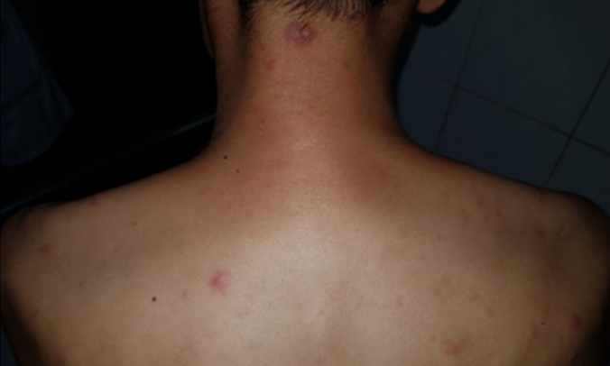Scattered red papules on the back, painful to press, in leprosy patients. Photo: Central Dermatology Hospital