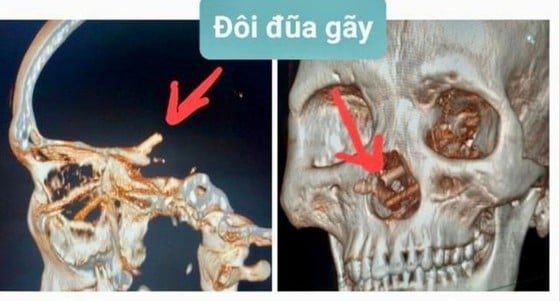 Chụp CT Scanner sọ não anh T phát hiện đôi đũa gãy