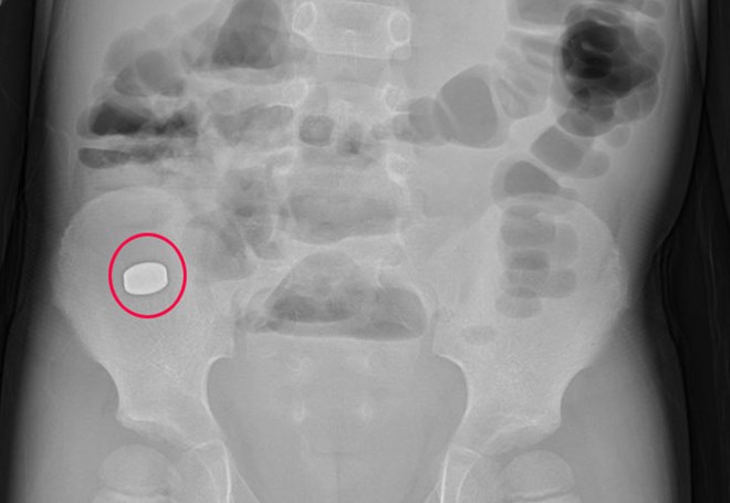 Un enfant de 5 ans de Quang Ninh a avalé un aimant dans un jouet