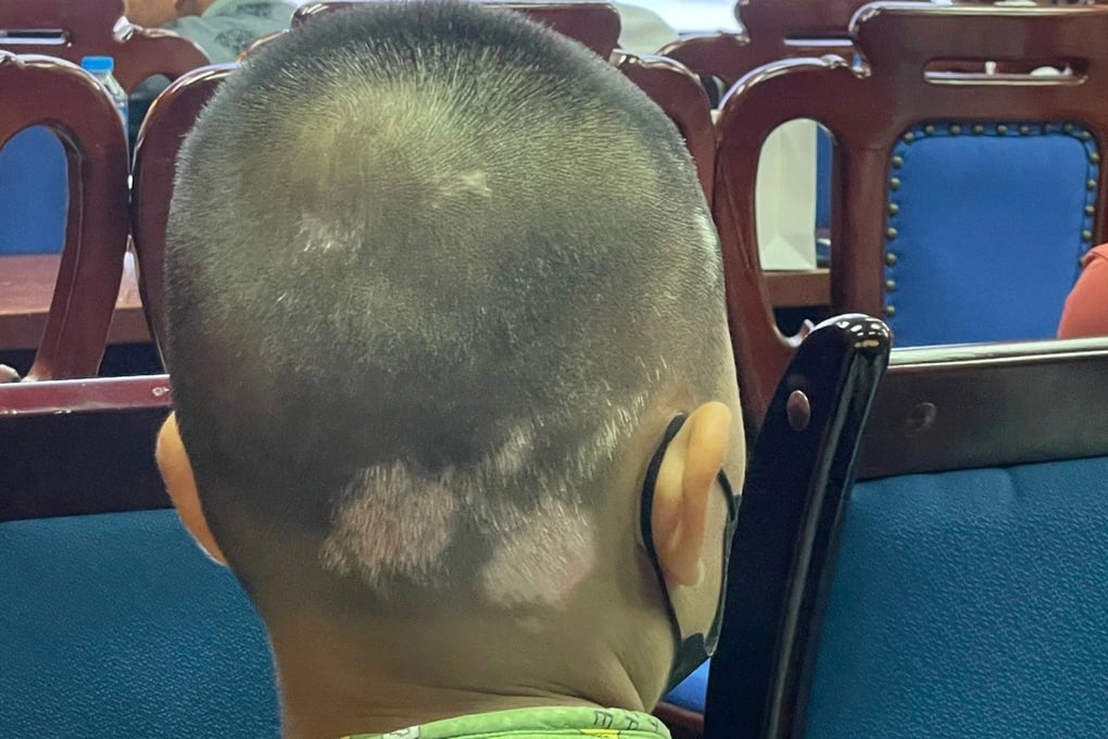 Bệnh bạch biến: Những đốm trắng loang lổ có thể trở về màu da bình thường - 1