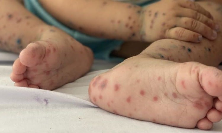 Ministry of Health requests increased monitoring of hand, foot and mouth disease patients