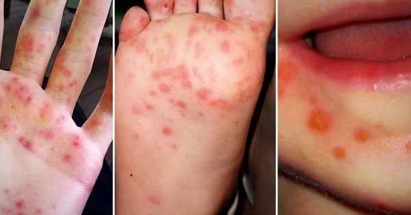 Les cas de maladie mains-pieds-bouche augmentent à Hanoi. Qui est susceptible d'être atteint de la maladie ?