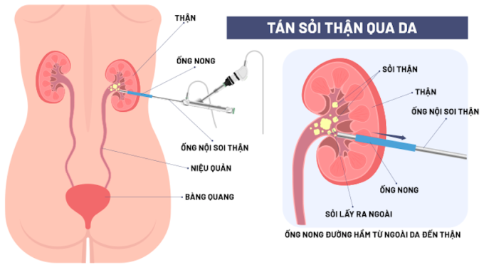 การจำลองการผ่าตัดไตด้วยวิธีผ่านผิวหนัง ภาพ: โรงพยาบาลทั่วไปทัมอันห์