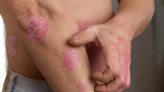 How to cure long-term psoriasis