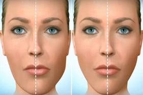 Facial asymmetry and how to fix it