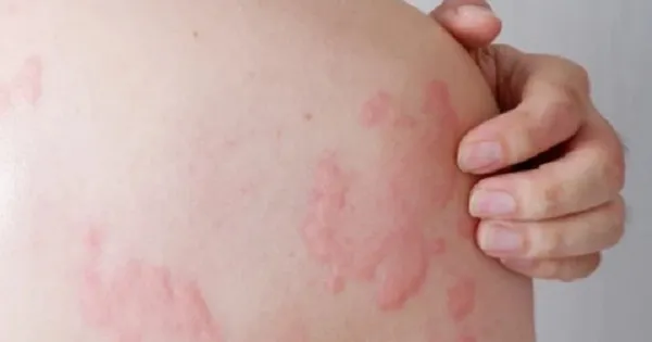 Is hives a sign of liver cancer?