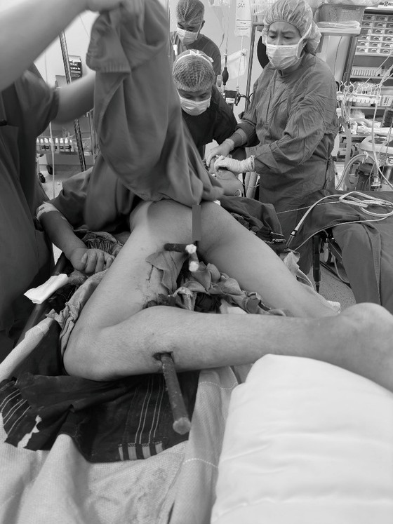 Cứu sống nam công nhân bị 3 cọc sắt đâm xuyên người ảnh 1