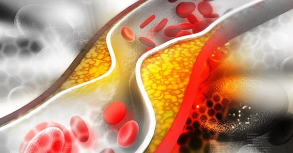 Dấu hiệu cảnh báo cholesterol cao