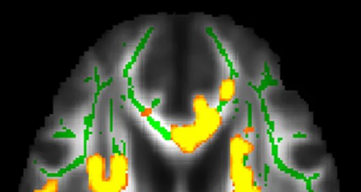 Mỡ nội tạng cao làm tăng nguy cơ mắc Alzheimer