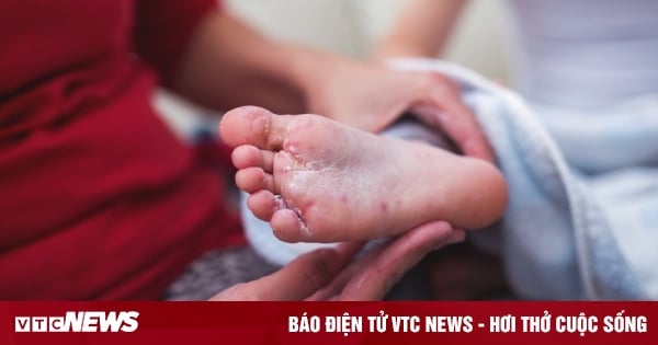 Aumenta el número de casos de enfermedad de manos, pies y boca en Hanoi y se descubre un nuevo brote