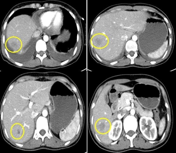 介入前の患者の腹部 CT スキャン。写真：病院提供