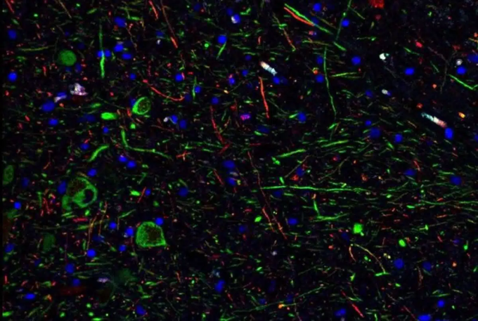 Dopamine neurons (green) in the brains of Covid-19 patients. Photo: Liuliu Yang