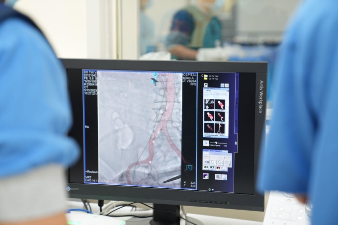 ប្រព័ន្ធ angiography ដកផ្ទៃខាងក្រោយជួយគ្រូពេទ្យធ្វើអន្តរាគមន៍ច្បាស់លាស់ដើម្បីទទួលបានលទ្ធផលល្អបំផុត។ រូបភាព៖ មន្ទីរពេទ្យ Tam Anh