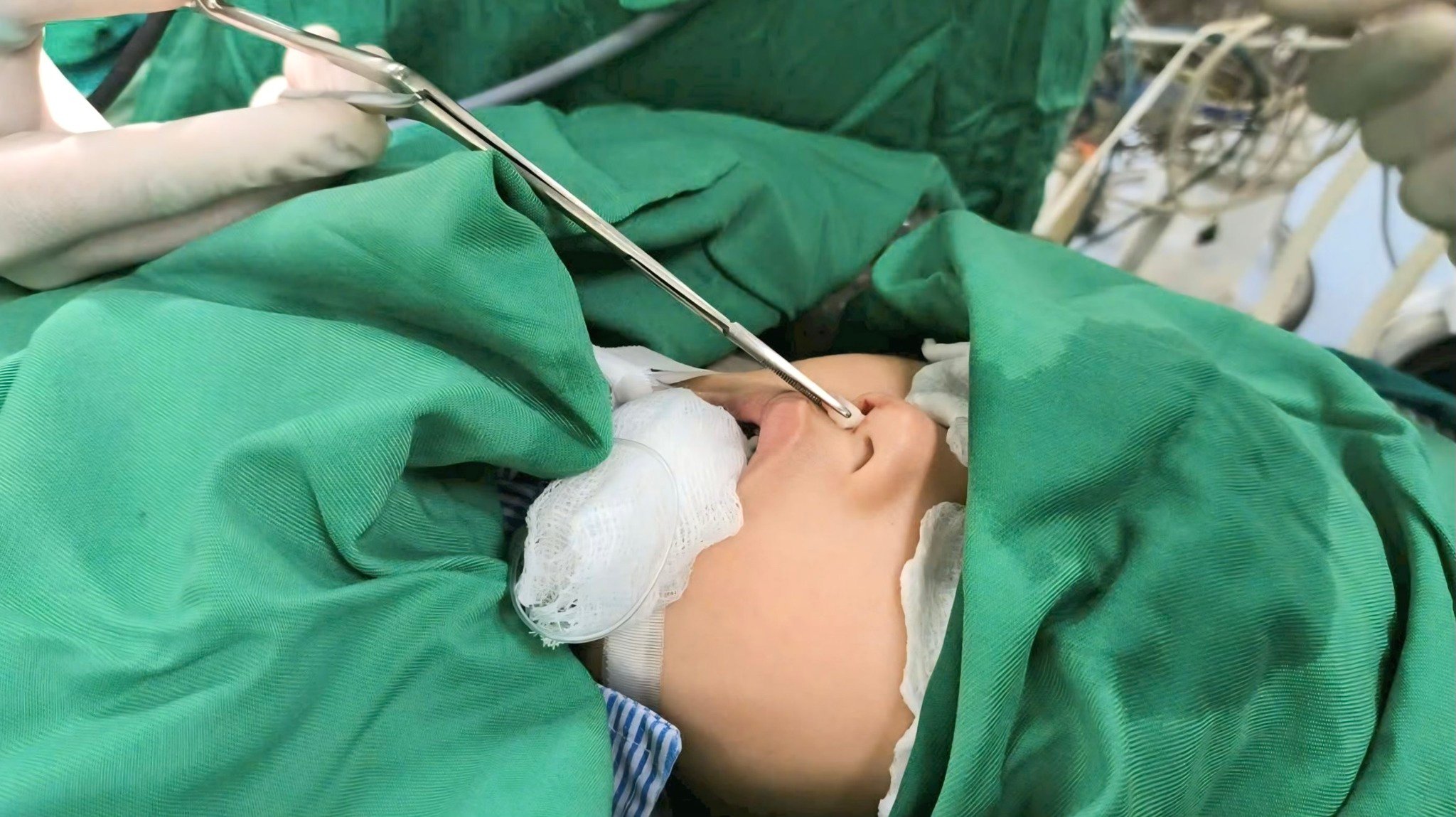 Bé trai 4 tuổi ở Bắc Giang có răng mọc ở… mũi - Ảnh 1.