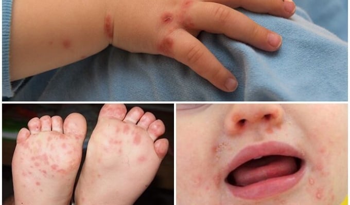 Hand, foot and mouth disease patients increase dramatically, what is the way to prevent it?