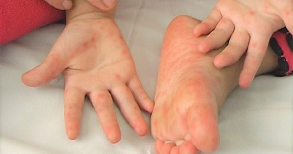 Détection d'une nouvelle épidémie, augmentation du nombre de cas de maladie pieds-mains-bouche à Hanoi