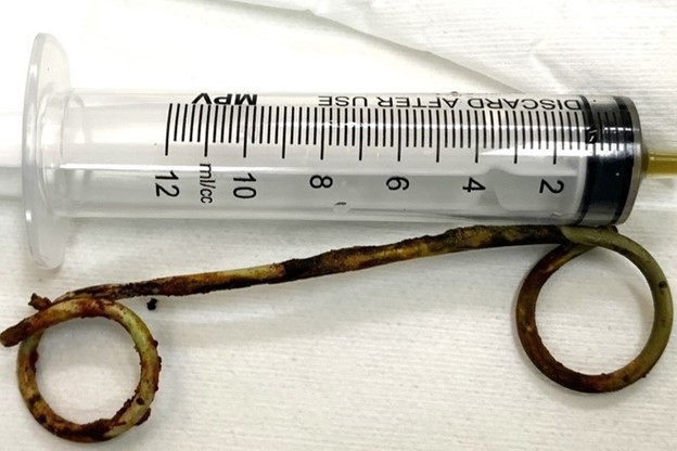 Hoffe, der 15cm lange Stent ist in der Geschichte Kubas im 6. Jahr des Jahres Bild 1 bekannt