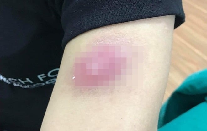 Tiêm tan mỡ giảm béo, cô gái trẻ nổi u cục khắp người - Ảnh 1.
