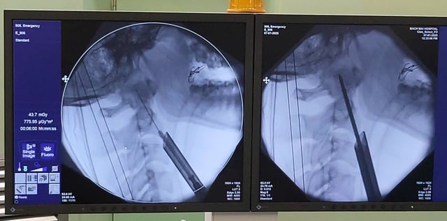 Cứu chữa thành công ca gãy cột sống cổ phức tạp bằng phẫu thuật nội soi - Ảnh 2.