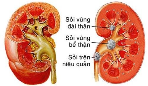 Phát hiện sỏi chi chít trong thận thanh niên 26 tuổi vì một sai lầm mà nhiều người Việt mắc phải- Ảnh 3.