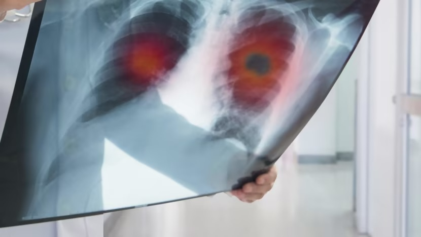 Recherche sur un nouveau médicament qui peut réduire de moitié le risque de décès par cancer du poumon 1