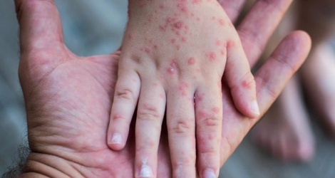 Measles outbreak may increase in the coming time