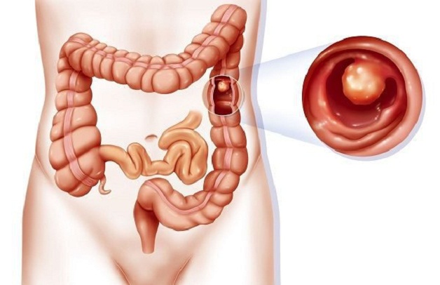 Đau bụng, khó đi tiêu, thanh niên 30 tuổi đi khám mới biết tắc ruột do bị u đại tràng, bác sĩ chỉ rõ 5 nhóm người cần cảnh giác - Ảnh 3.