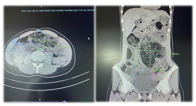 Une femme qui avait mangé beaucoup de fruits a dû être hospitalisée en raison d'une occlusion intestinale. Image 1