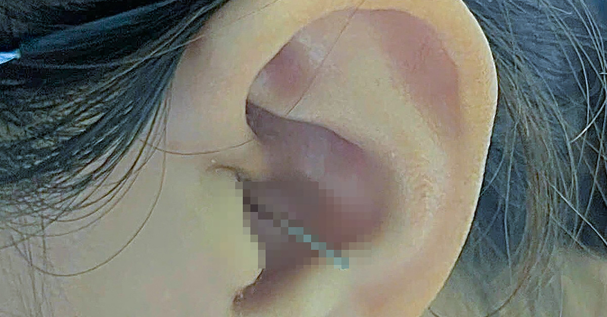 Le mari serre soudainement sa femme dans ses bras alors qu'elle se nettoie l'oreille, ce qui fait pénétrer un objet étranger profondément dans l'oreille gauche