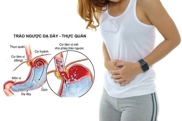 Dấu hiệu ho do bị trào ngược dạ dày, rất nhiều người không biết  - Ảnh 3.