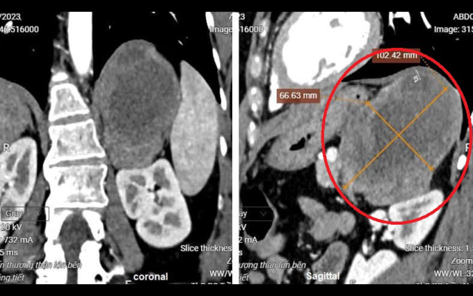 Khối u trên phim cắt lớp vi tính (vòng tròn đỏ). Ảnh: Bệnh viện cung cấp