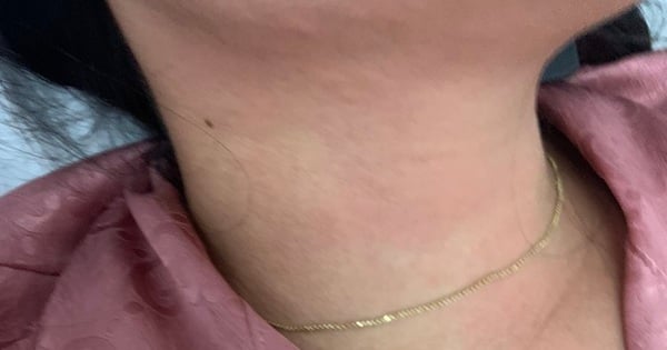 Difficulty breathing, rash after eating coconut worms