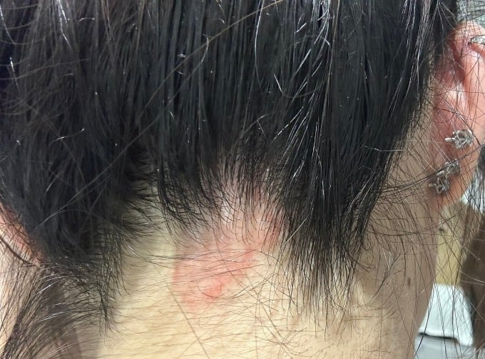 La peau de Mme Ngan semblait rouge, gonflée et couverte de cloques après une journée passée à se teindre les cheveux. Photo : fournie par le docteur