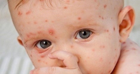 Clarifying the reasons why measles cases are increasing