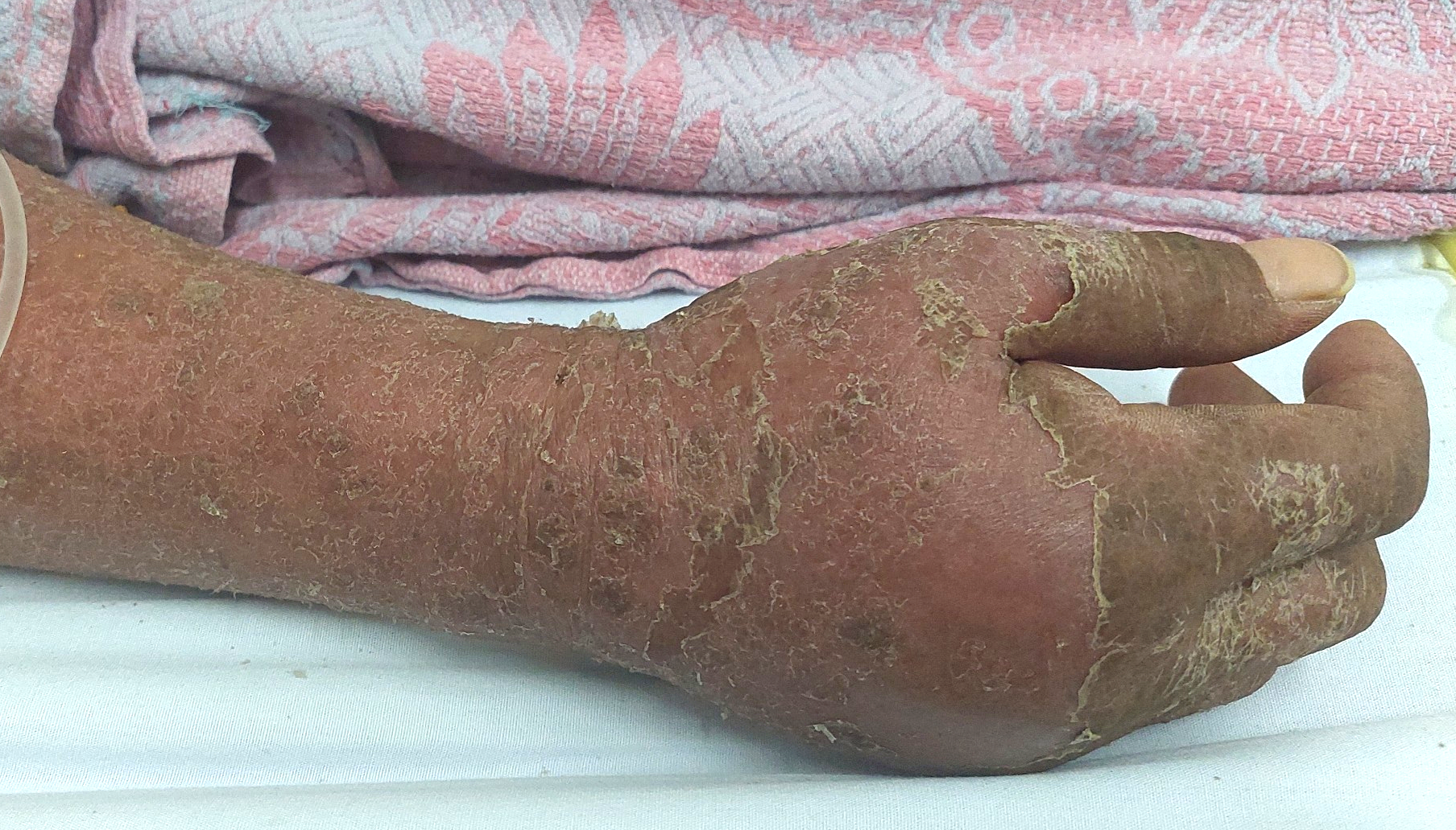 Người đàn ông suy gan, thận do dị ứng thuốc kháng lao - Ảnh 1.