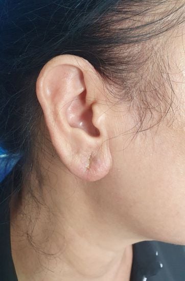 귀 필러 주입 후 감염 합병증. 사진: 병원 제공