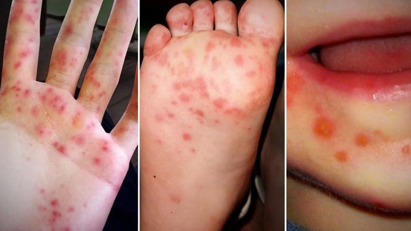 Information on the lack of medicine to treat hand, foot and mouth disease, what does the Ministry of Health say? Image 1