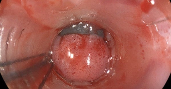 Alcoholism for many years, man has cirrhosis, esophageal varices